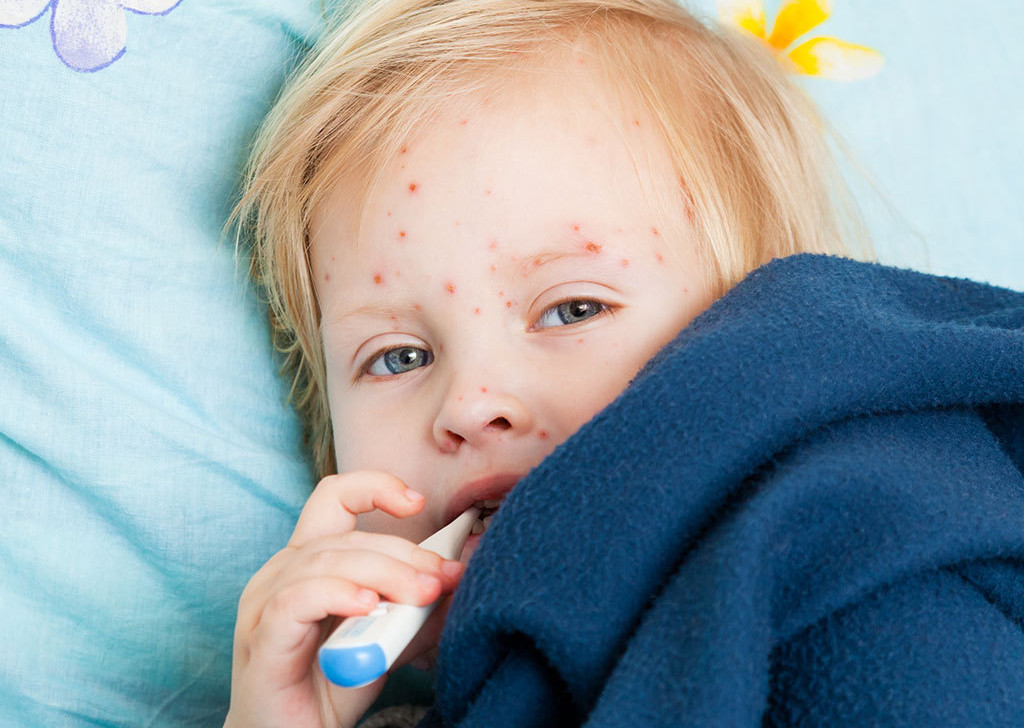 Ветрянка и корь. Учимся различать