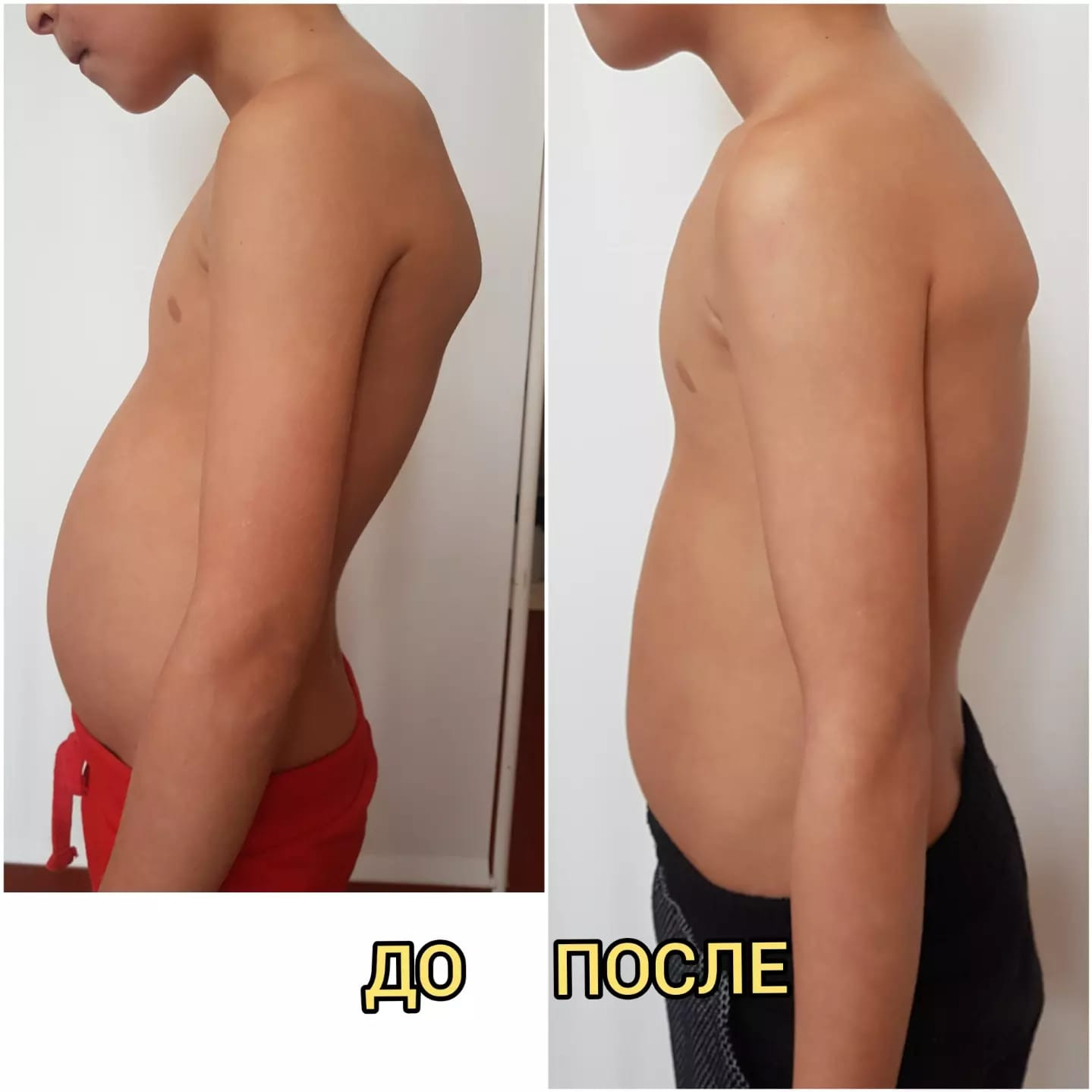 Гиперлордоз. Работа массажистов До и После.