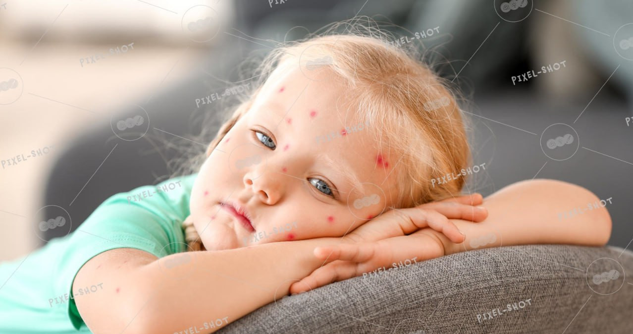 Ветрянка и корь. В чем отличия? Как избежать заражения?